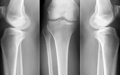 Osteoporose pode causar fratura de tornozelo?
